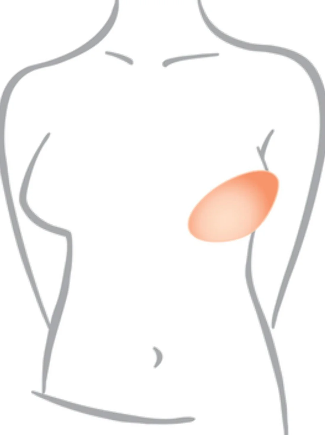 Amoena Balance Contact Varia Partial Breast Shaper - SV286 - Image 3