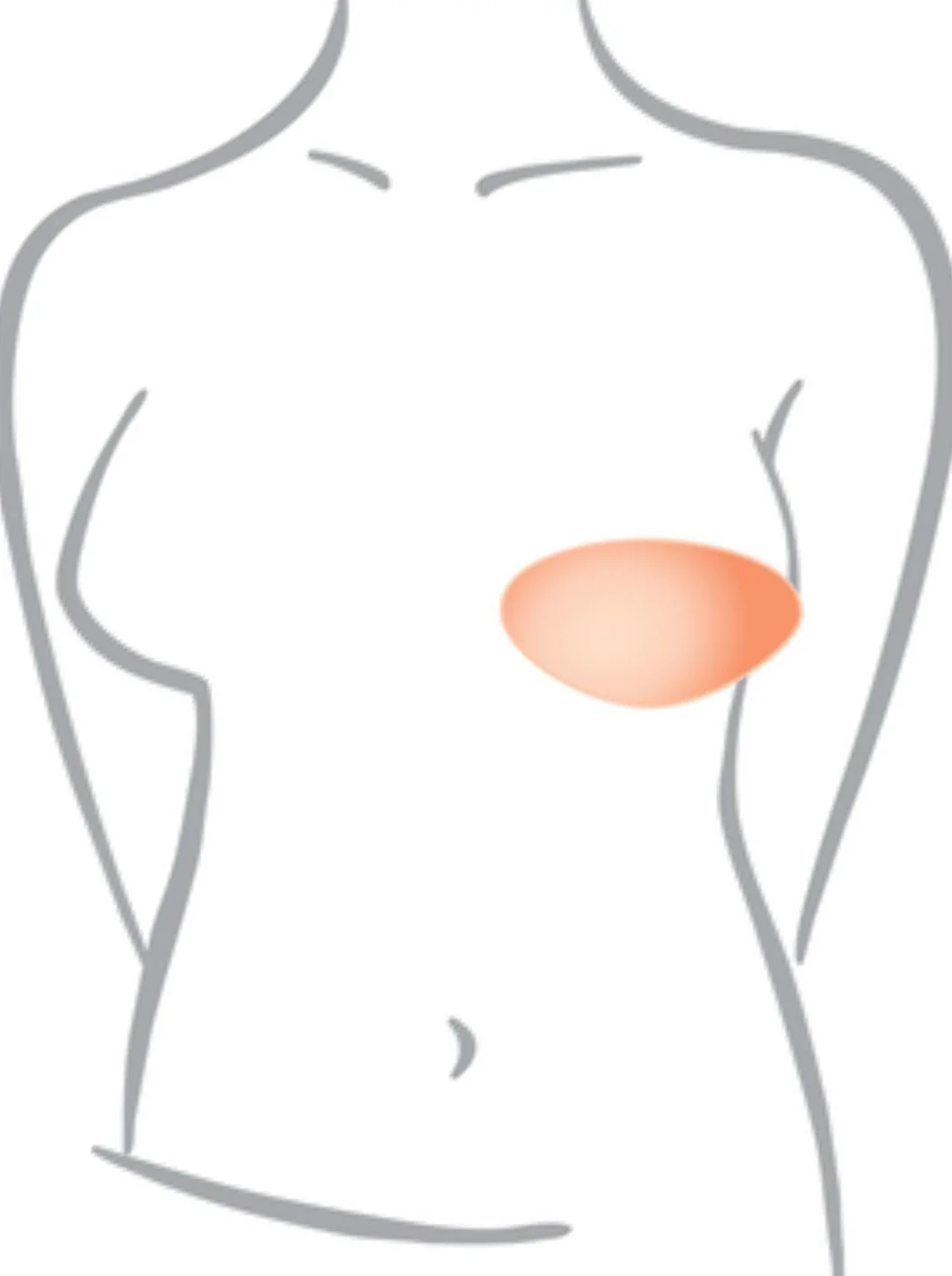 Amoena Balance Contact Varia Partial Breast Shaper - SV286 - Image 5